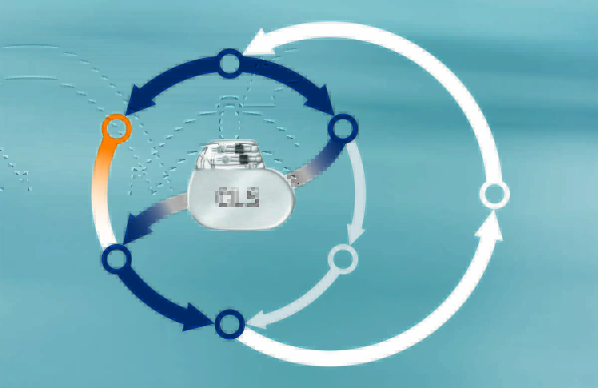 CLS – Closed Loop Stimulation